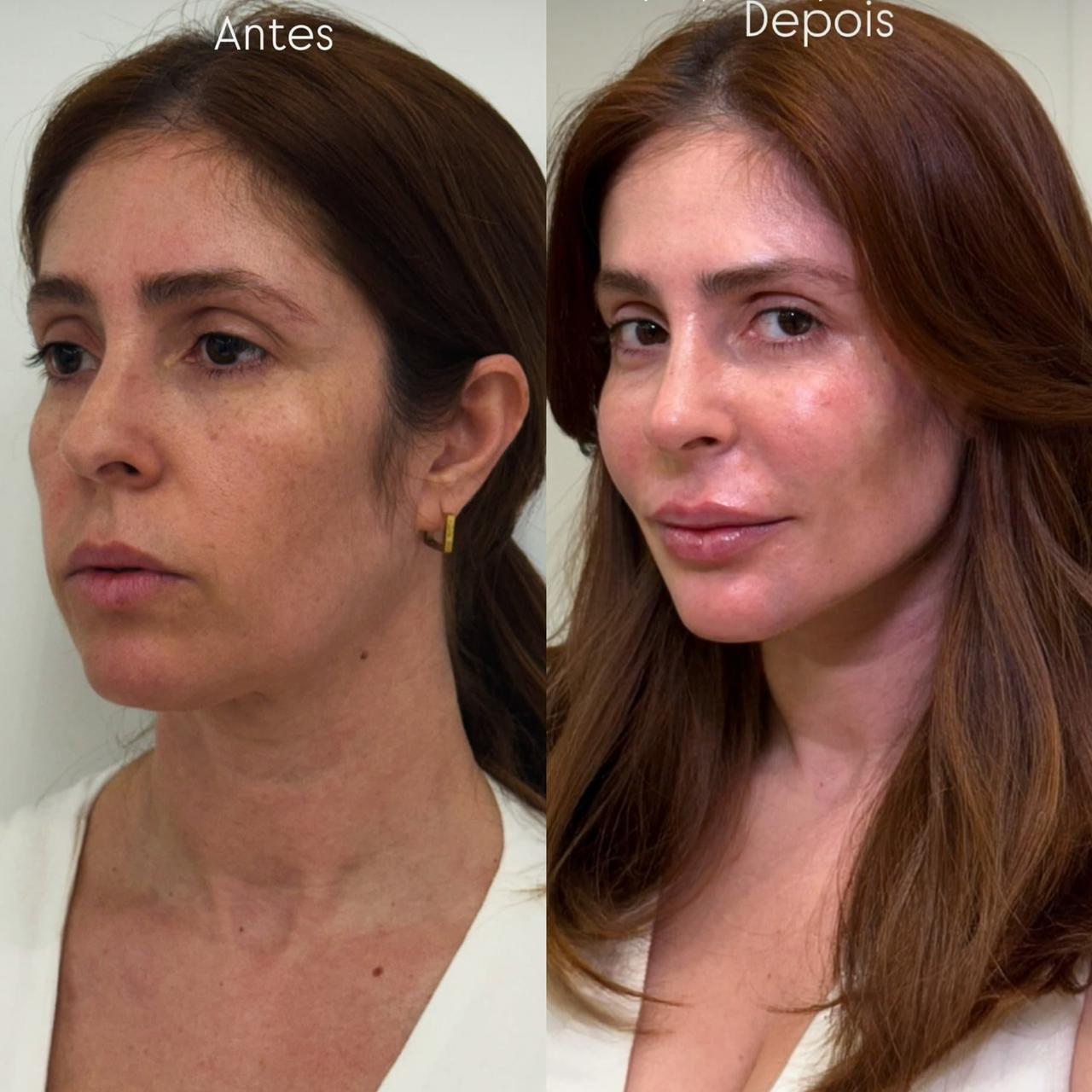Antes e depois — Harmonização facial completa