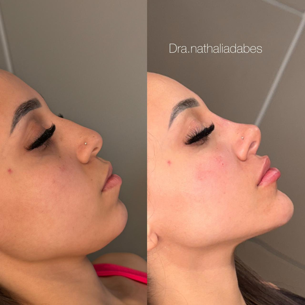 Antes e depois — Contorno de perfil