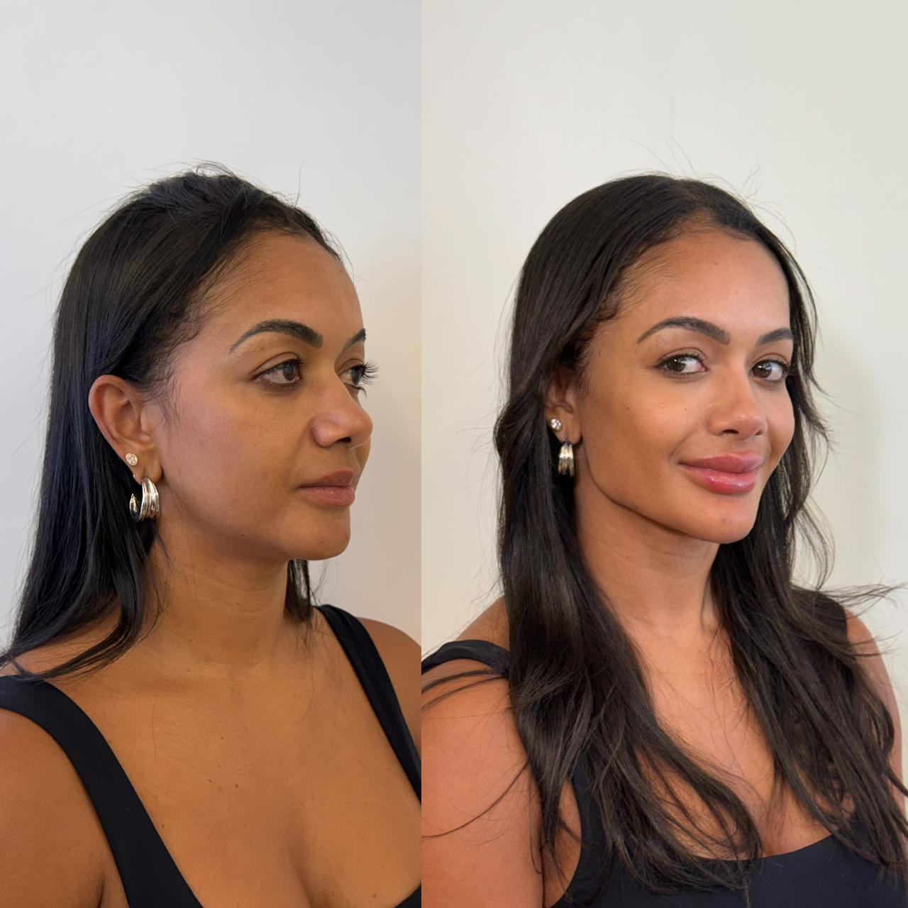 Antes e depois — Harmonização e rejuvenescimento