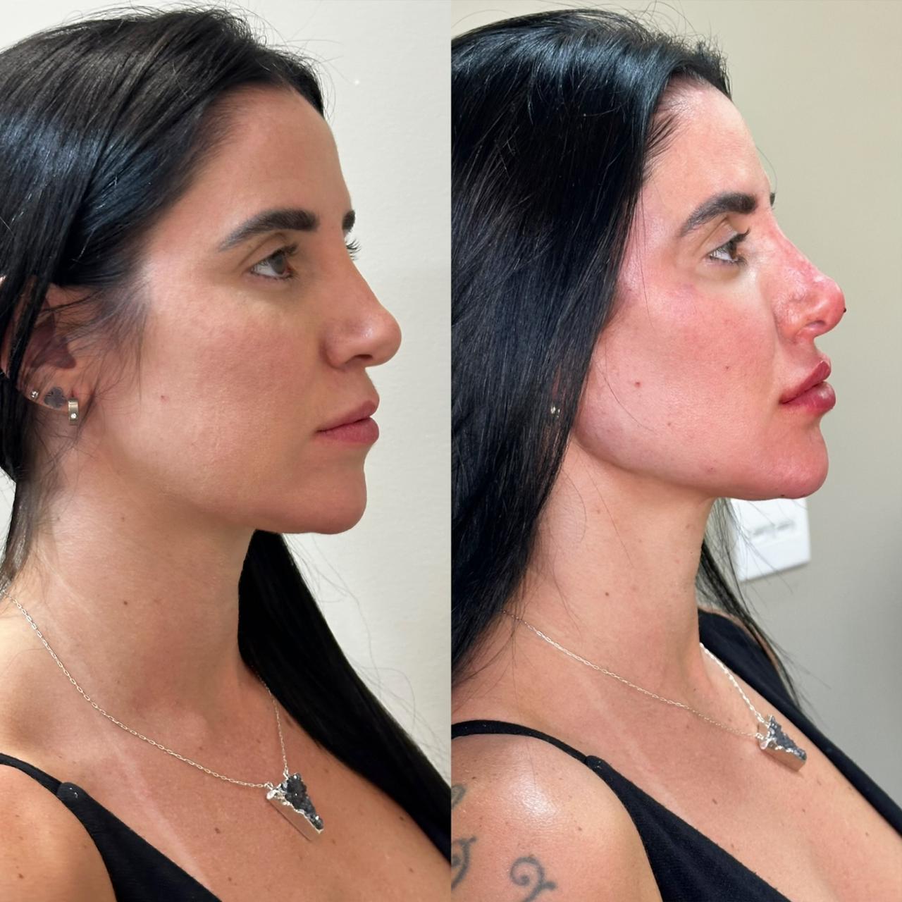 Antes e depois — Contorno facial lateral