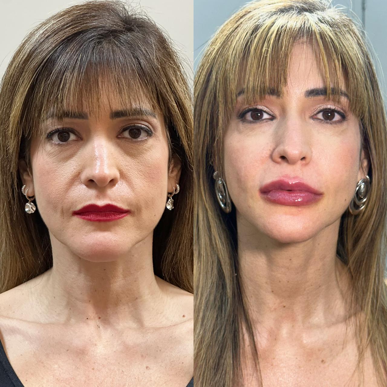 Antes e depois — Harmonização facial frontal