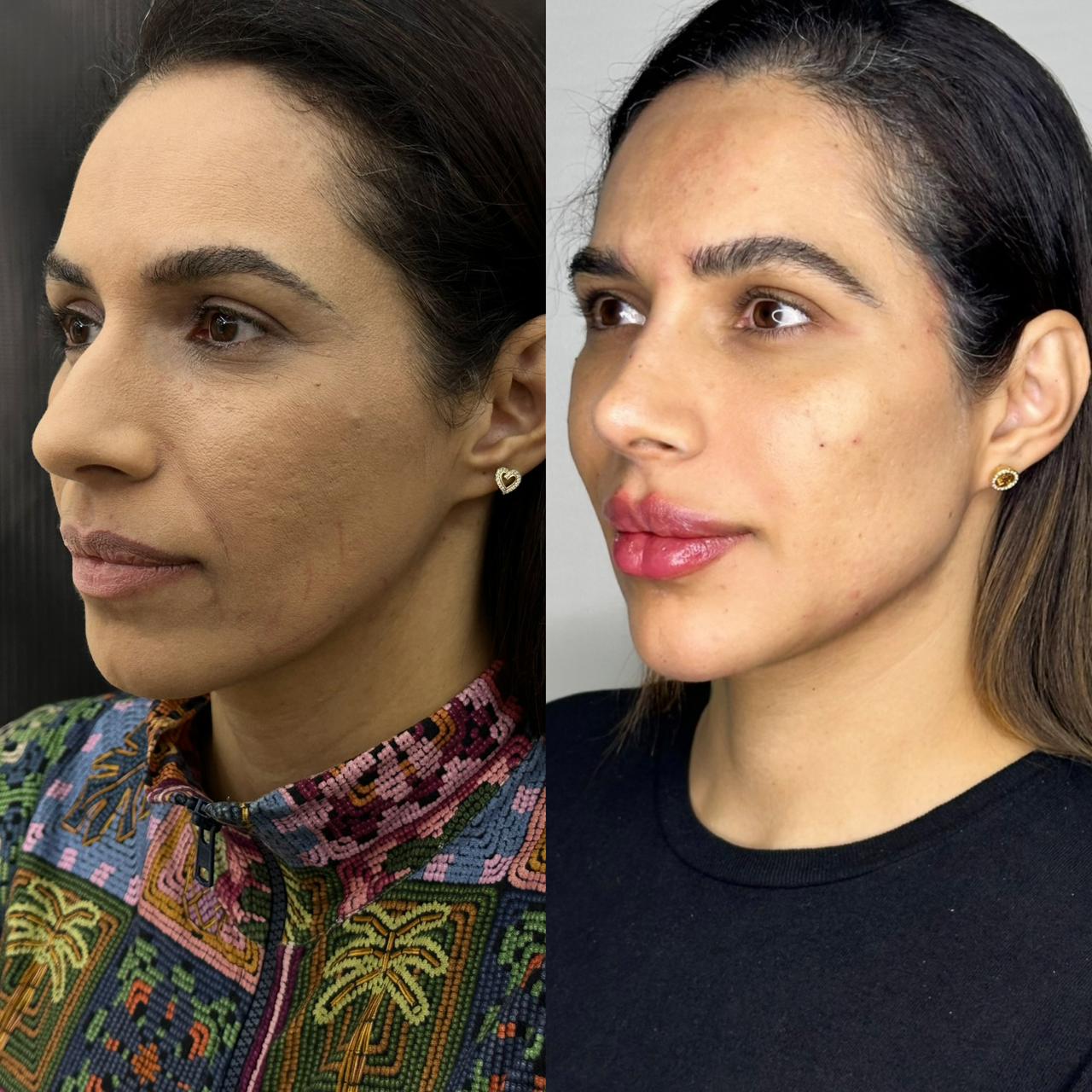 Antes e depois — Volumização e contorno