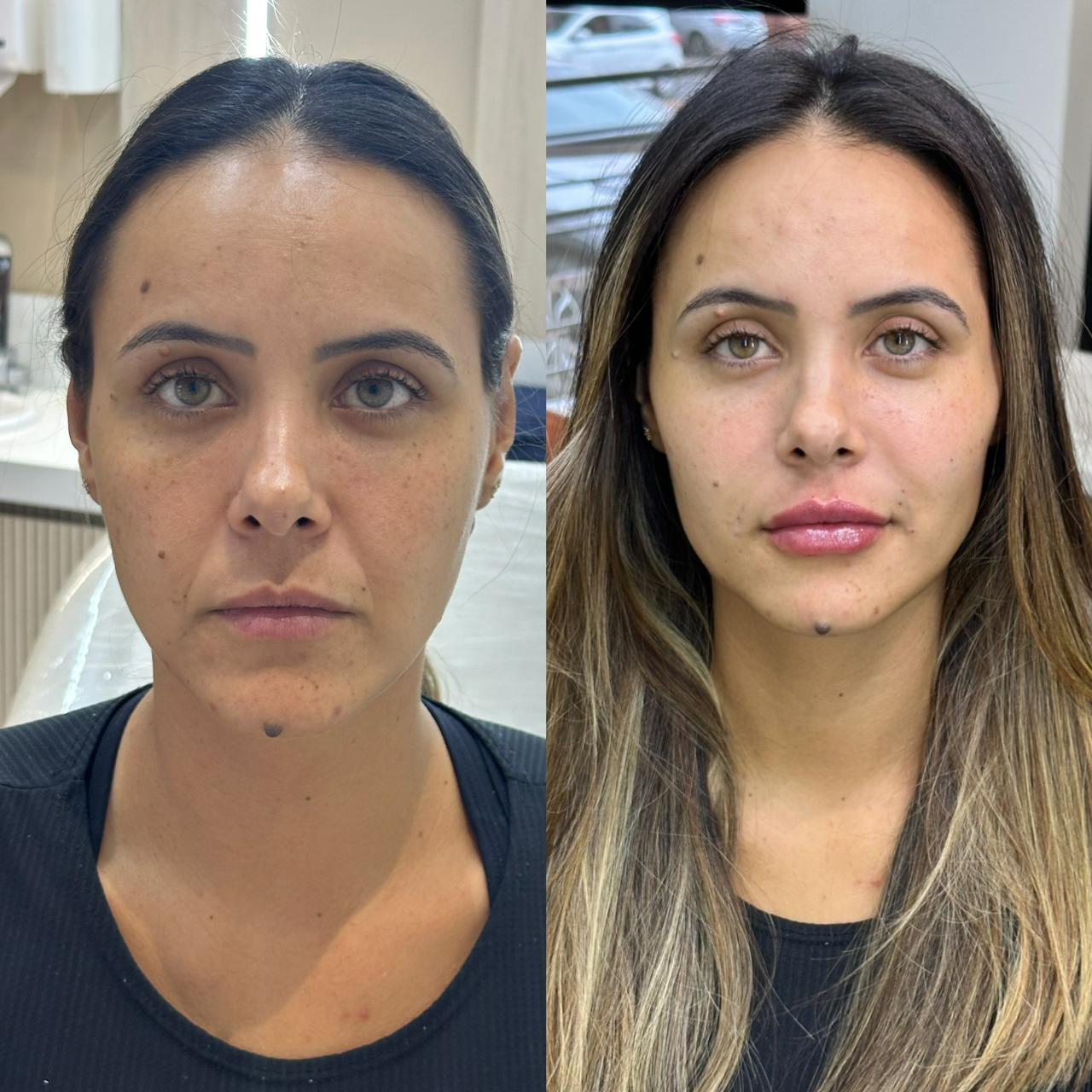 Antes e depois — Rejuvenescimento facial