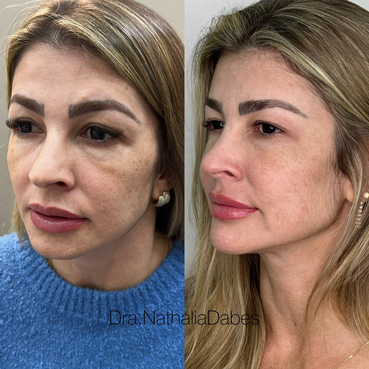 Antes e depois — Harmonização completa